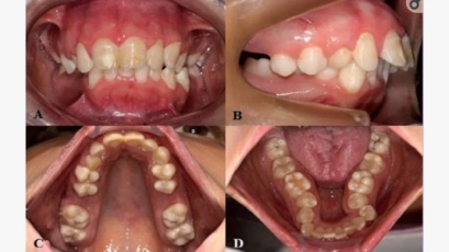 High-arched narrow palate – with abnormal tooth shape (C). Copyright : © 2018 Medicina Oral S.L.