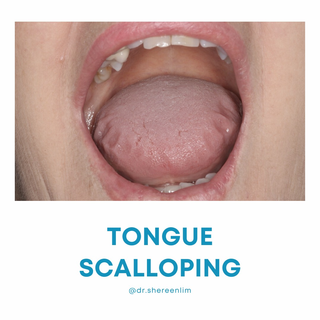 Tongue Scalloping